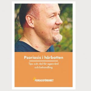 Psoriasis i hårbotten_WEBB